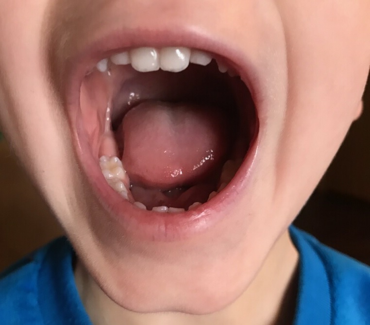 first bite pediatric dentistry